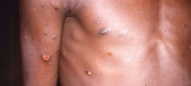 España participa este lunes en una reunión con otros países de la UE para analizar la emergencia sanitaria de mpox