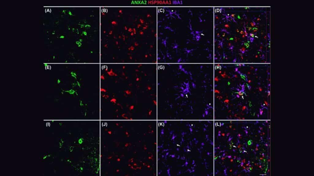 Una investigación de UCLM que identifica tres proteínas asociadas al alzhéimer podría mejorar diagnóstico y tratamiento