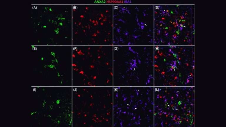 Una investigación de UCLM que identifica tres proteínas asociadas al alzhéimer podría mejorar diagnóstico y tratamiento